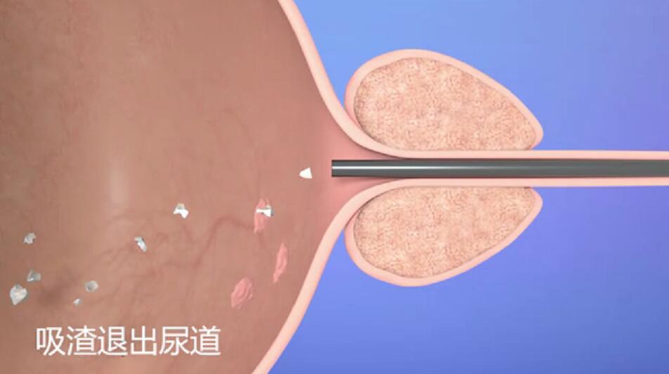 膀胱腫瘤的檢查.jpg 膀胱腫瘤的檢查.jpg