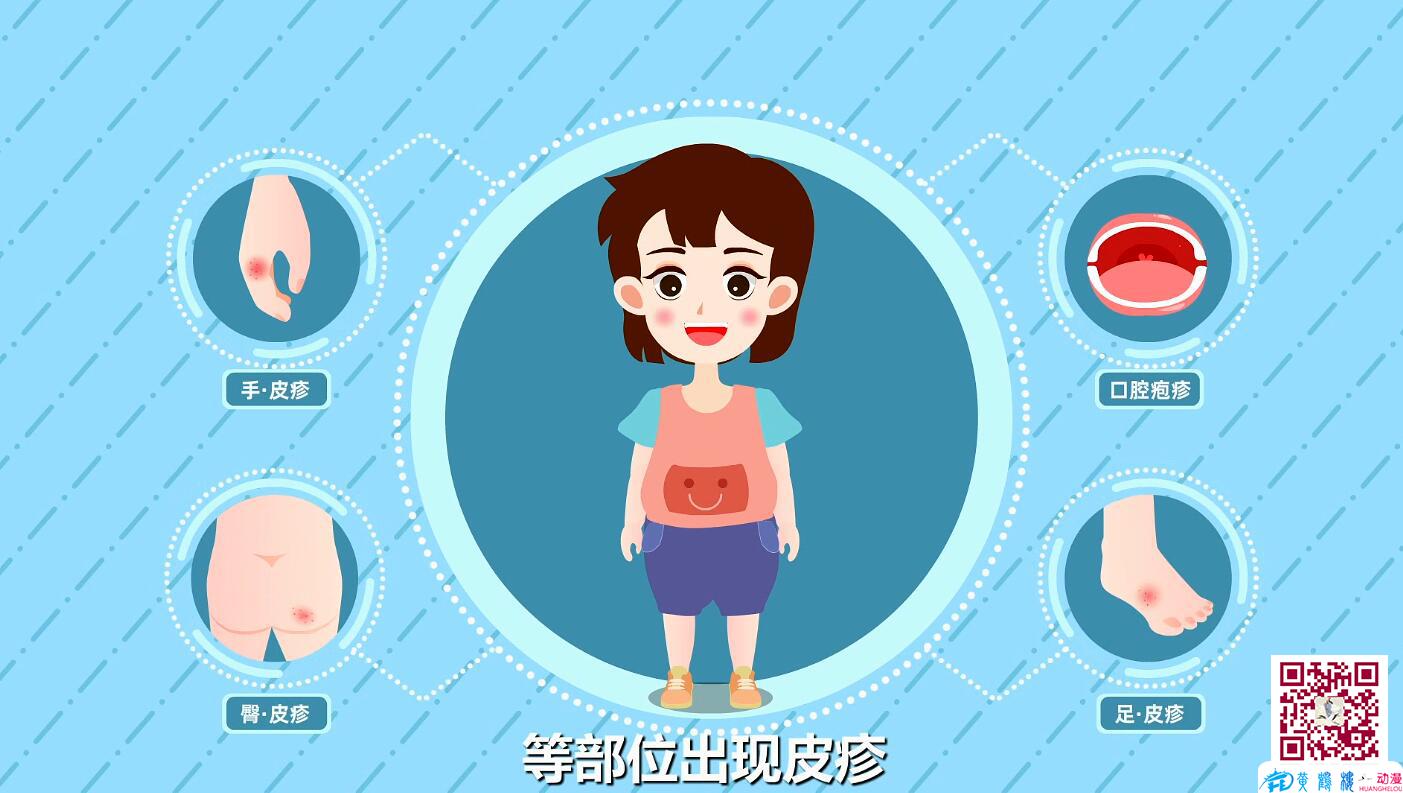 手足口病防治小知識(shí)早期癥狀身體.jpg 手足口病防治小知識(shí)早期癥狀身體.jpg