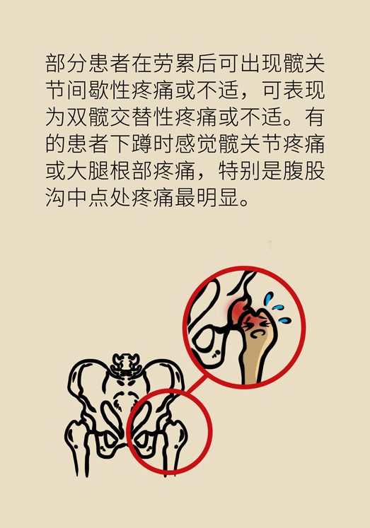 激素會帶來股骨頭壞死的后遺癥嗎？