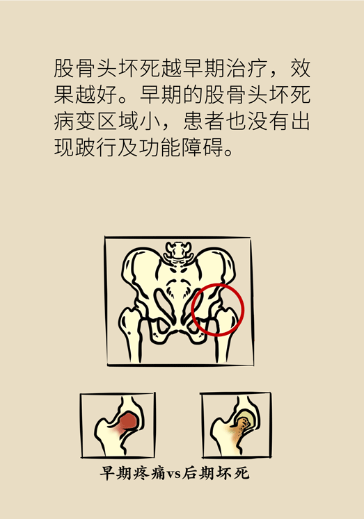 激素會帶來股骨頭壞死的后遺癥嗎？