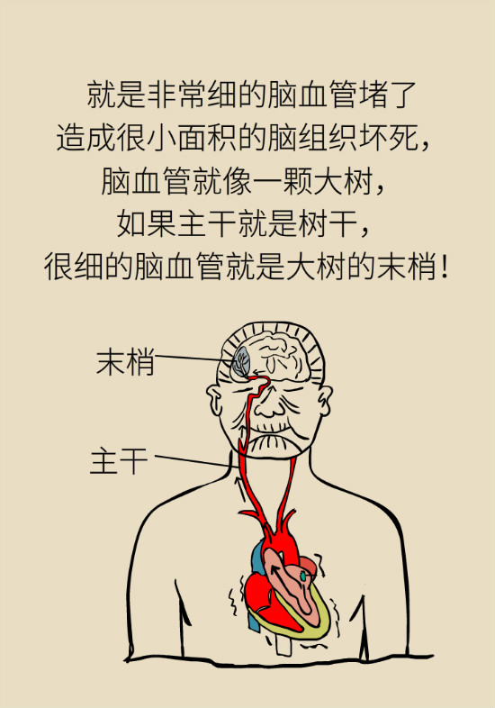 腔隙性腦梗死一定是腦血管堵了嗎？