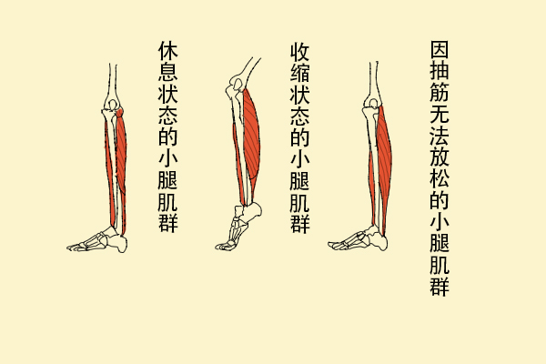 為什么缺鈣會(huì)導(dǎo)致抽筋？