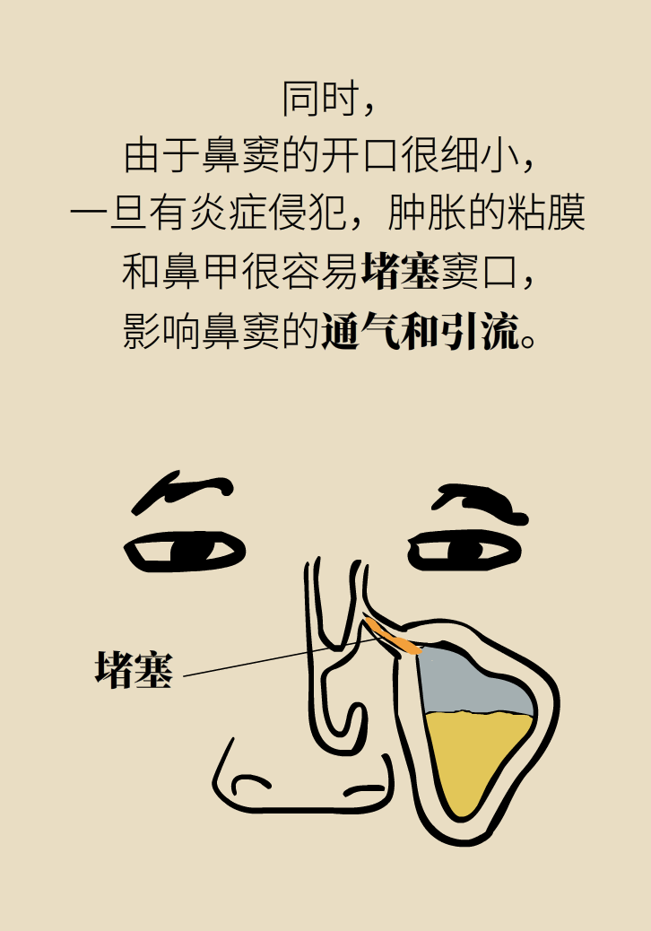 為什么鼻竇發(fā)炎，疼的卻是頭、眼和牙？