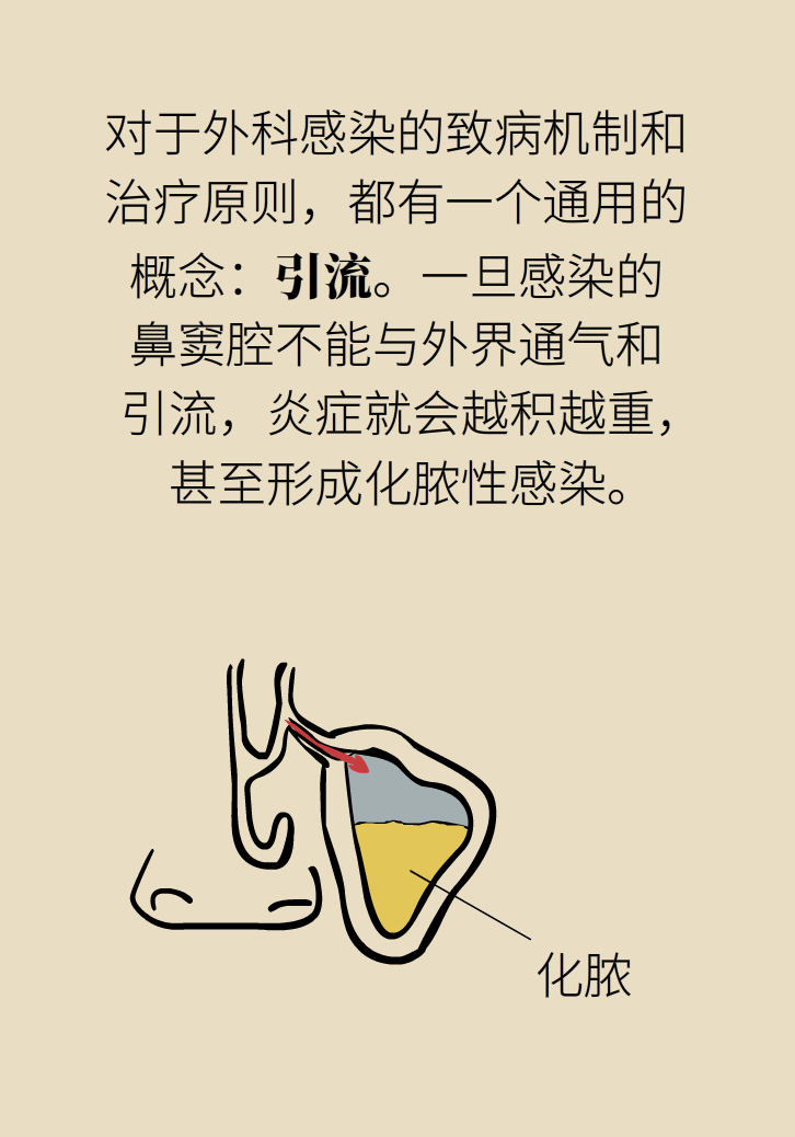 為什么鼻竇發(fā)炎，疼的卻是頭、眼和牙？