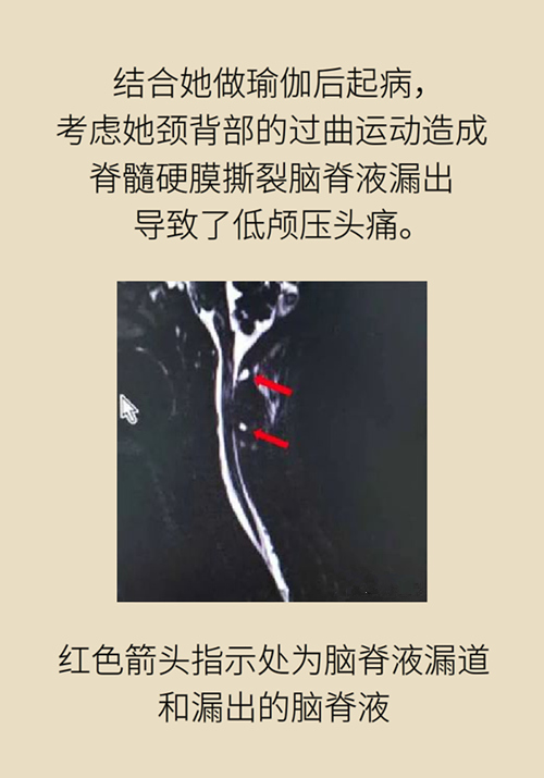 練瑜伽把腦脊液拉漏了！常見(jiàn)的“瑜伽病”你知道多少