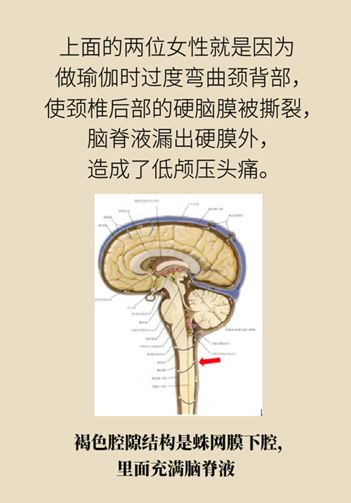 練瑜伽把腦脊液拉漏了！常見(jiàn)的“瑜伽病”你知道多少
