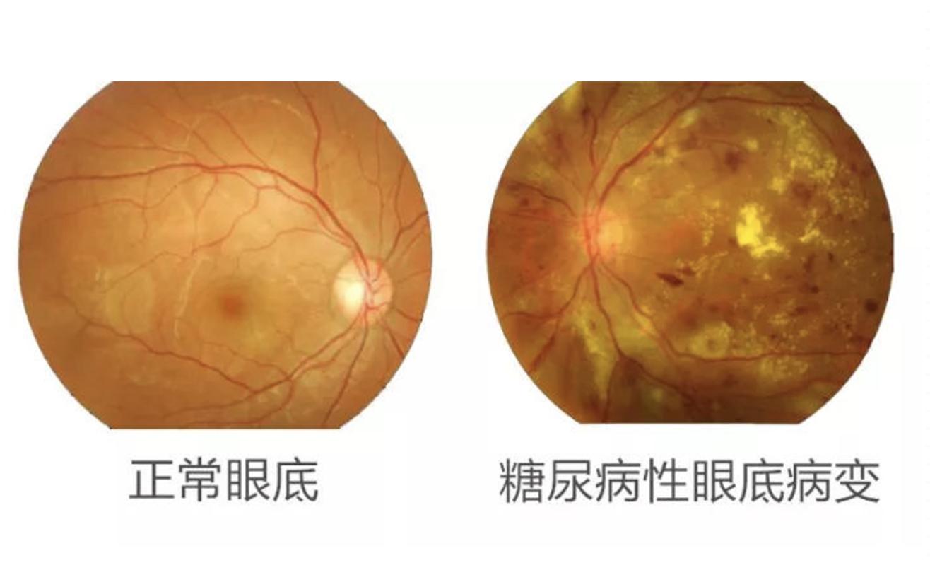 糖尿病患者出現(xiàn)這個癥狀，可能是失明前兆