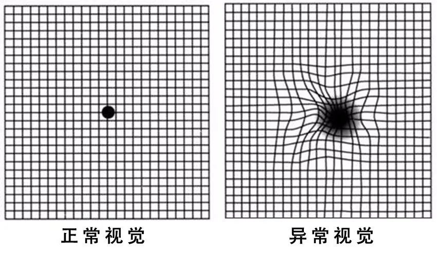 糖尿病患者出現(xiàn)這個癥狀，可能是失明前兆