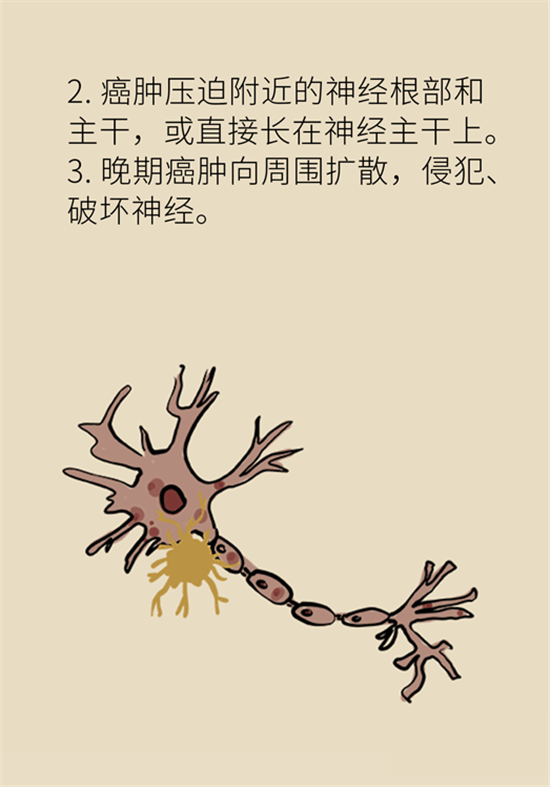 癌癥到底有多痛？需要注意這7個(gè)重點(diǎn)問題