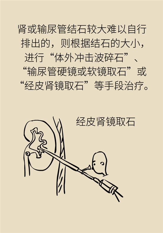 結(jié)石科普：身體里多了各種結(jié)石，應(yīng)該怎么辦？