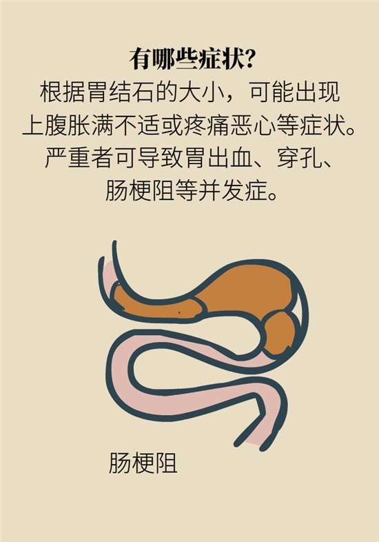 結(jié)石科普：身體里多了各種結(jié)石，應(yīng)該怎么辦？