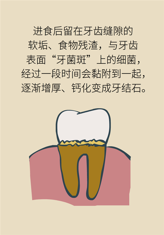 結(jié)石科普：身體里多了各種結(jié)石，應(yīng)該怎么辦？