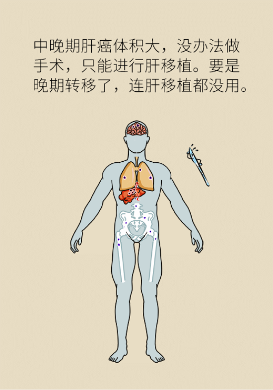 論發(fā)現(xiàn)早期肝癌的本事，cfDNA比AFP更精準，比影像學更早一步