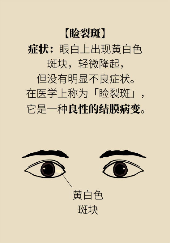 眼白有斑塊、出血要緊嗎？專家：名字唬人但問題不大