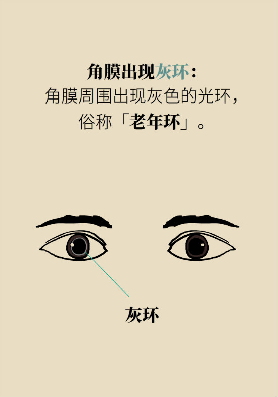 眼白有斑塊、出血要緊嗎？專家：名字唬人但問題不大
