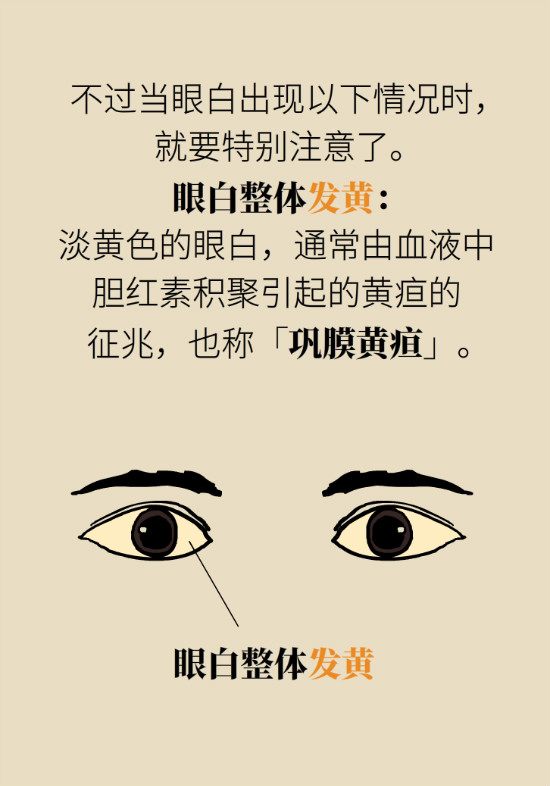 眼白有斑塊、出血要緊嗎？專家：名字唬人但問題不大