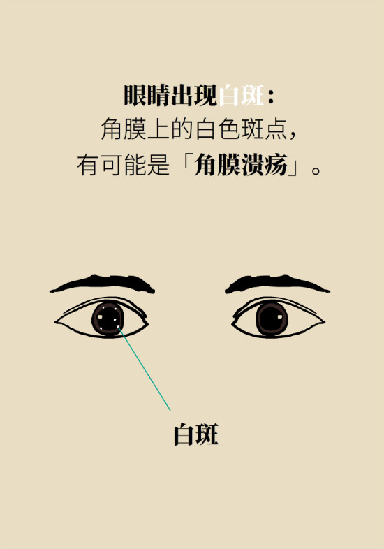 眼白有斑塊、出血要緊嗎？專家：名字唬人但問題不大