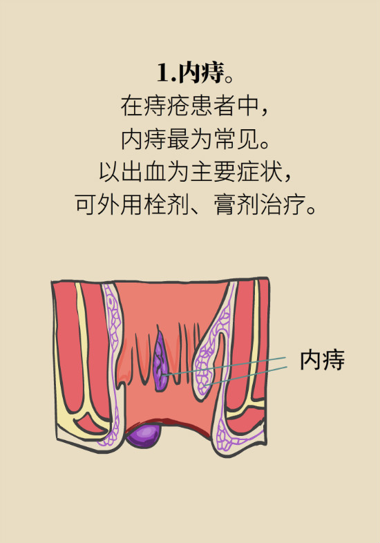 長“痔”如何久安？專家的建議來了