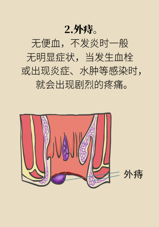 長“痔”如何久安？專家的建議來了