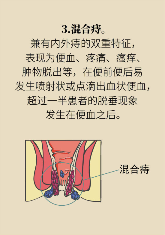 長“痔”如何久安？專家的建議來了