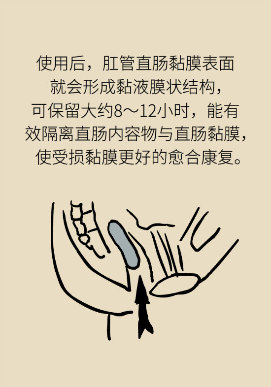長“痔”如何久安？專家的建議來了