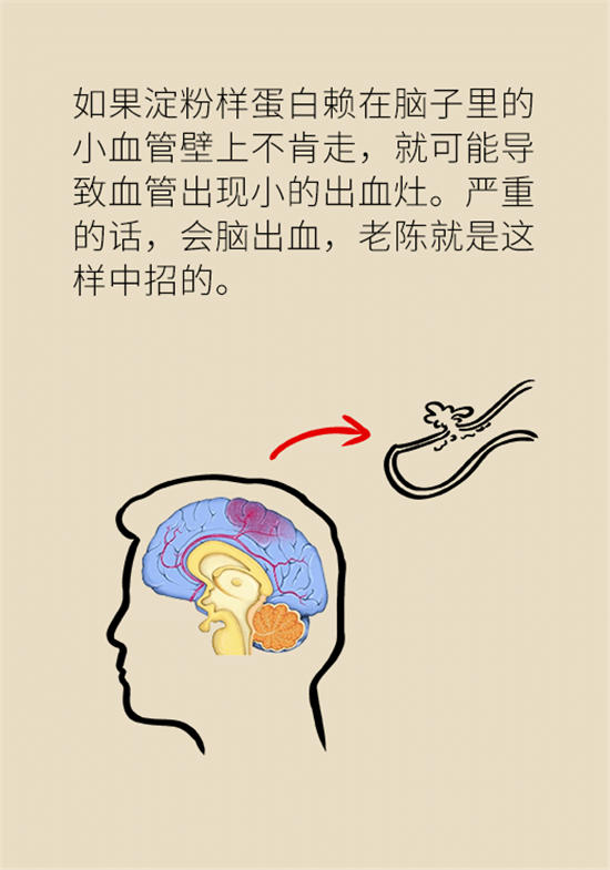 身體出現(xiàn)這些癥狀要小心，可能是腦出血發(fā)出的信號(hào)