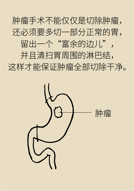胃癌手術(shù)一定要全切胃？專家：視情況而定