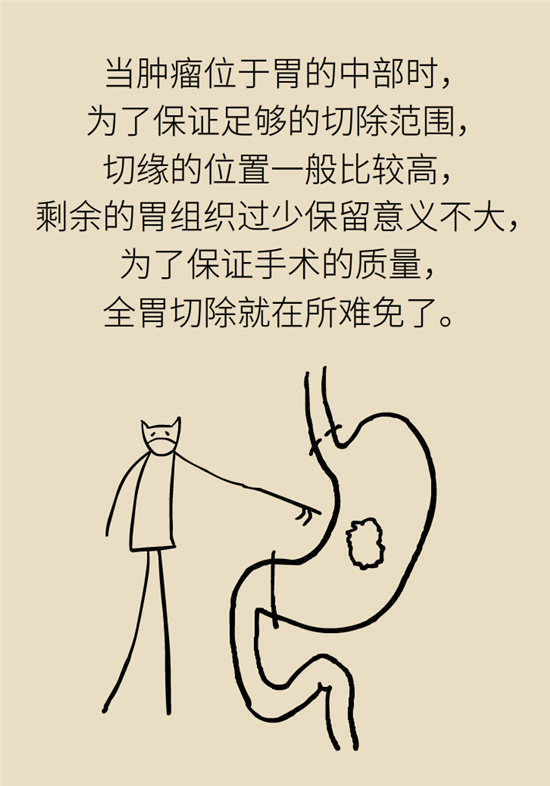 胃癌手術(shù)一定要全切胃？專家：視情況而定