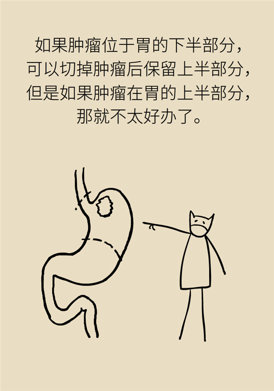 胃癌手術(shù)一定要全切胃？專家：視情況而定