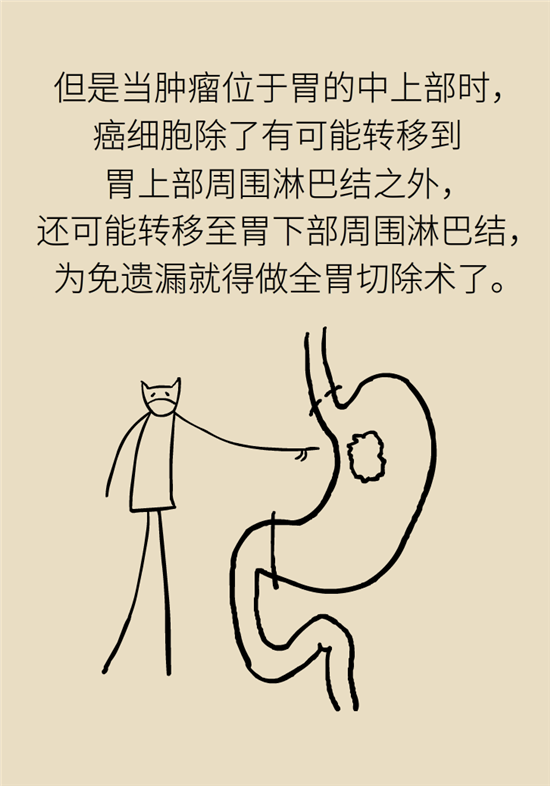 胃癌手術(shù)一定要全切胃？專家：視情況而定