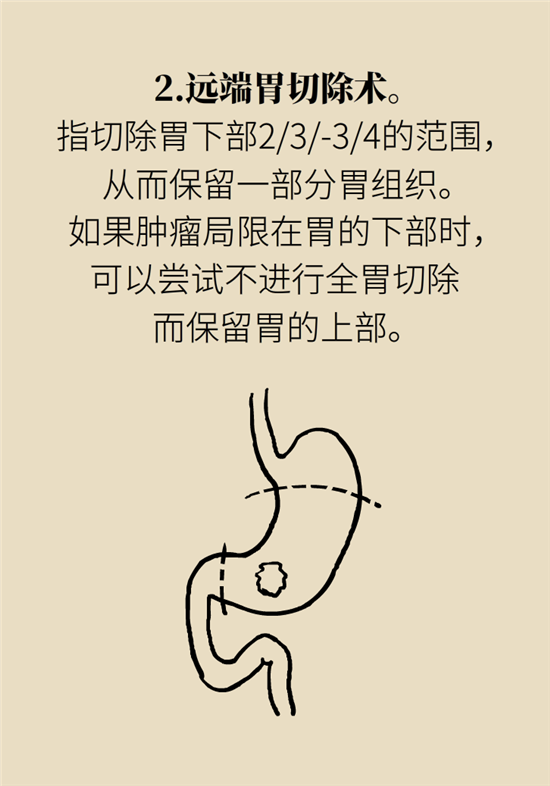 胃癌手術(shù)一定要全切胃？專家：視情況而定