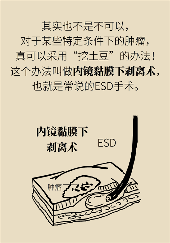 胃癌手術(shù)一定要全切胃？專家：視情況而定