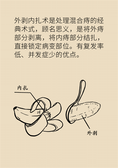 肛門腫脹還有血？小心痔瘡找上門