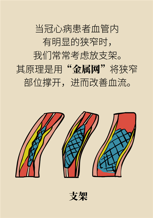 為什么裝完支架猝死風險還增高了？都是因為這些壞習慣