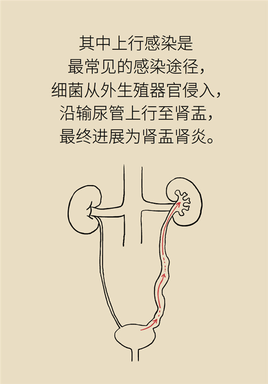 經(jīng)常憋尿會得急性腎炎？