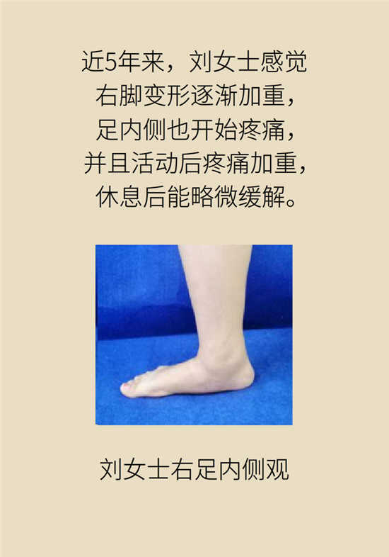 走幾百米路就疼得不行了？可能患上了平足癥