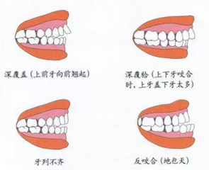 兒童換牙常見(jiàn)3大問(wèn)題，保護(hù)牙齒需要做好這5點(diǎn)