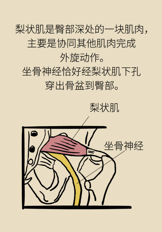 梨狀肌綜合征 梨狀肌綜合征