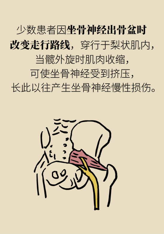 梨狀肌綜合征 梨狀肌綜合征