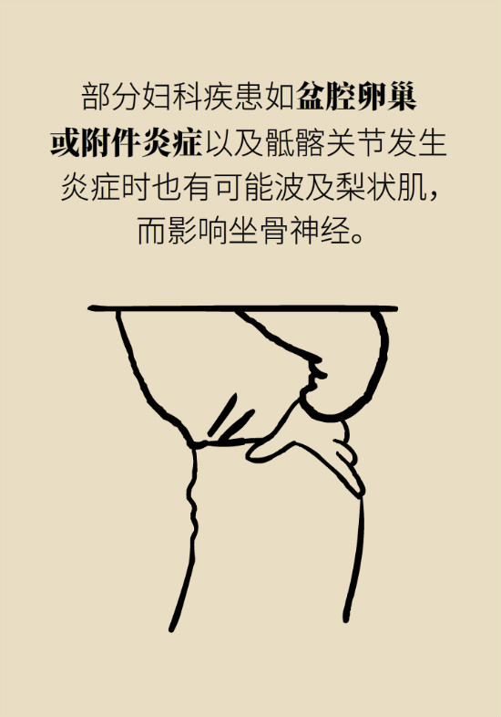 梨狀肌綜合征 梨狀肌綜合征