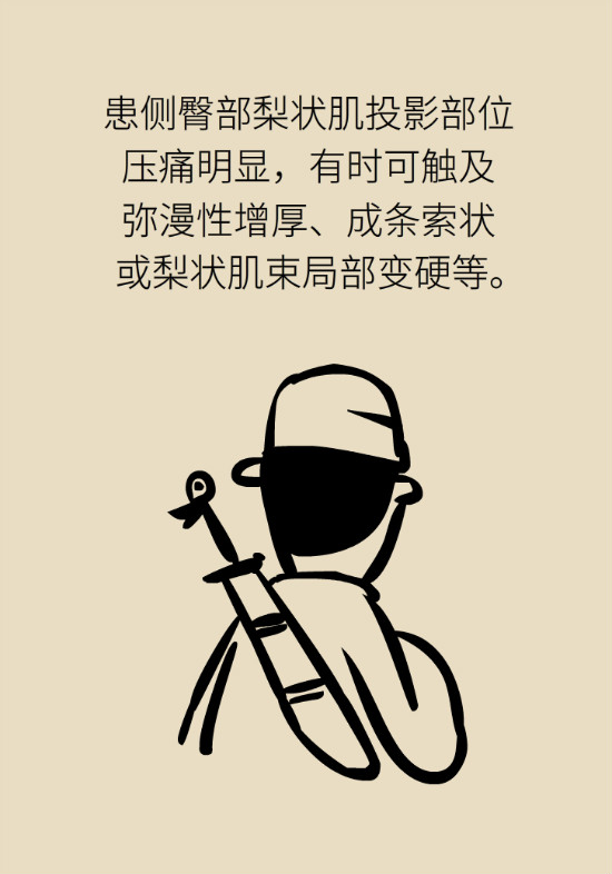 梨狀肌綜合征 梨狀肌綜合征