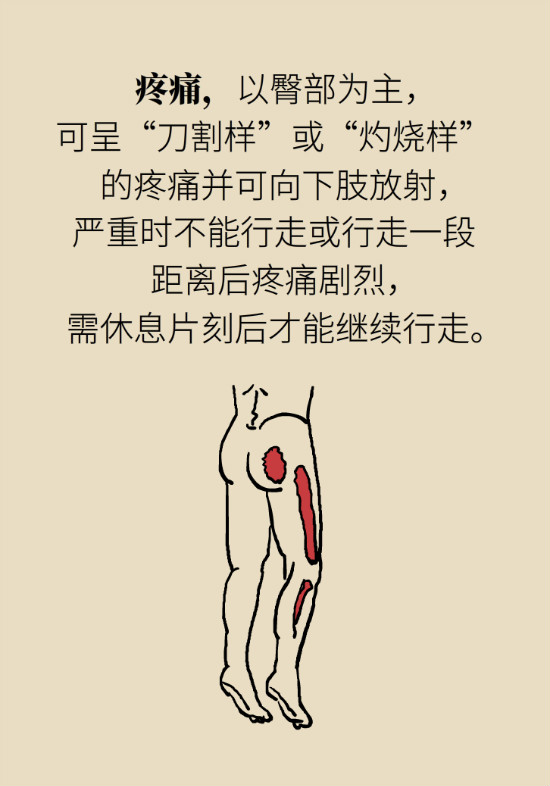 梨狀肌綜合征 梨狀肌綜合征