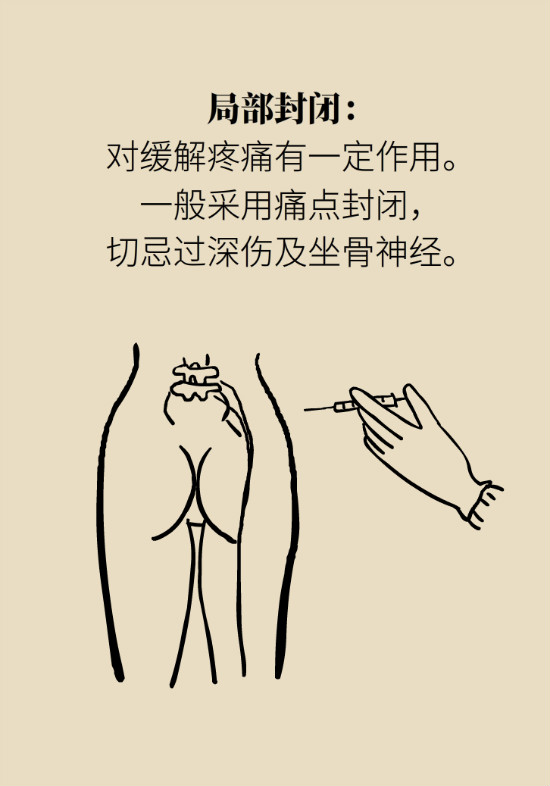 梨狀肌綜合征 梨狀肌綜合征