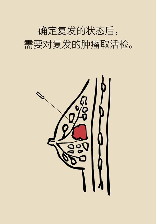 乳腺癌復(fù)發(fā)、轉(zhuǎn)移了怎么辦？