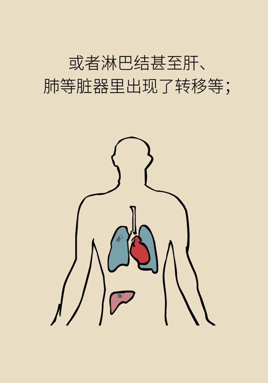 乳腺癌復(fù)發(fā)、轉(zhuǎn)移了怎么辦？
