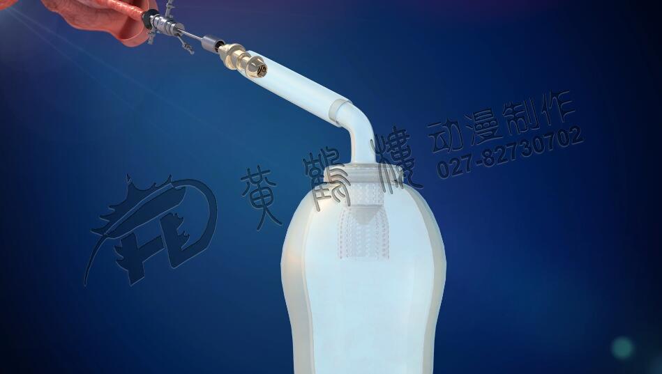 前列腺手術(shù)抗反流收集裝置.jpg 前列腺手術(shù)抗反流收集裝置.jpg