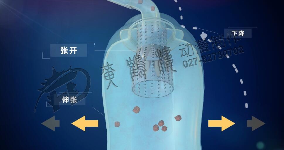 前列腺手術(shù)抗反流收集裝置工作原理.jpg 前列腺手術(shù)抗反流收集裝置工作原理.jpg
