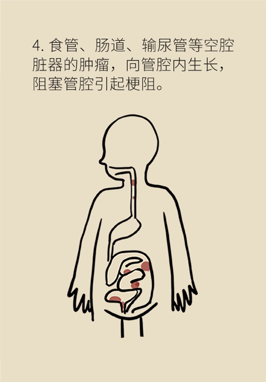 癌癥醫(yī)學知識科普動漫制作