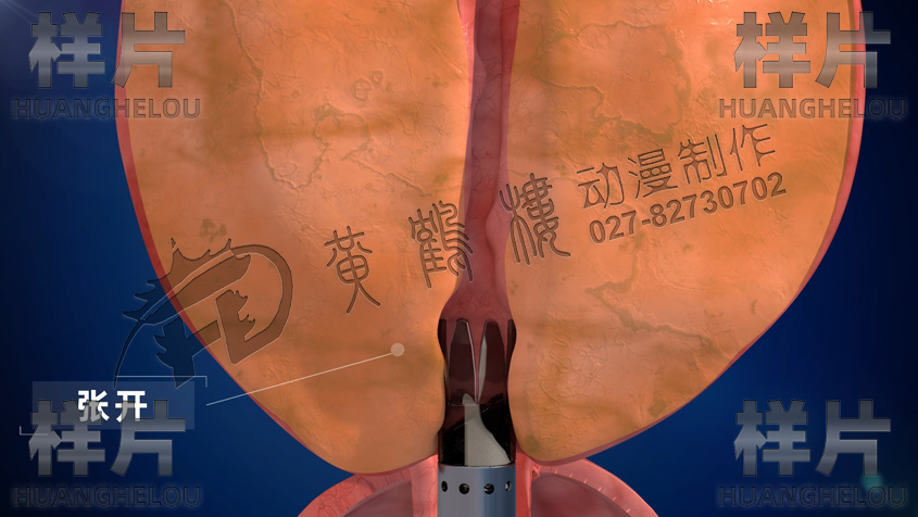 電刀保護鞘插入.jpg 電刀保護鞘插入.jpg