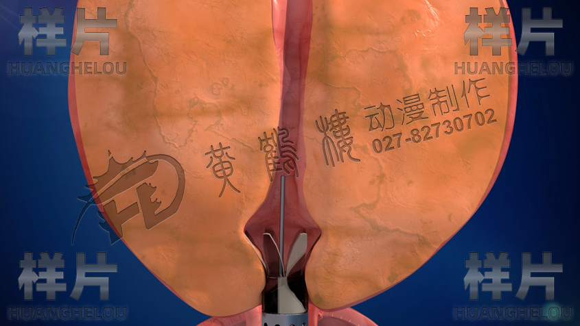 尿道保護鞘張開.jpg 尿道保護鞘張開.jpg